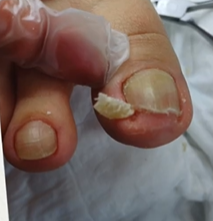 Topuk Çatlağı Bakımı