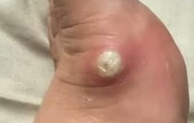 Topuk Çatlağı Bakımı