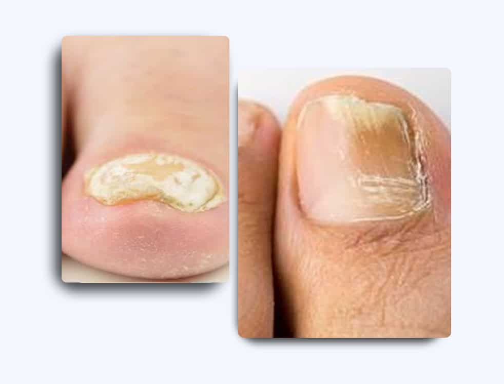 Topuk Çatlağı Bakımı