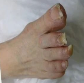 Topuk Çatlağı Bakımı