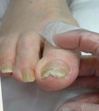 Topuk Çatlağı Bakımı